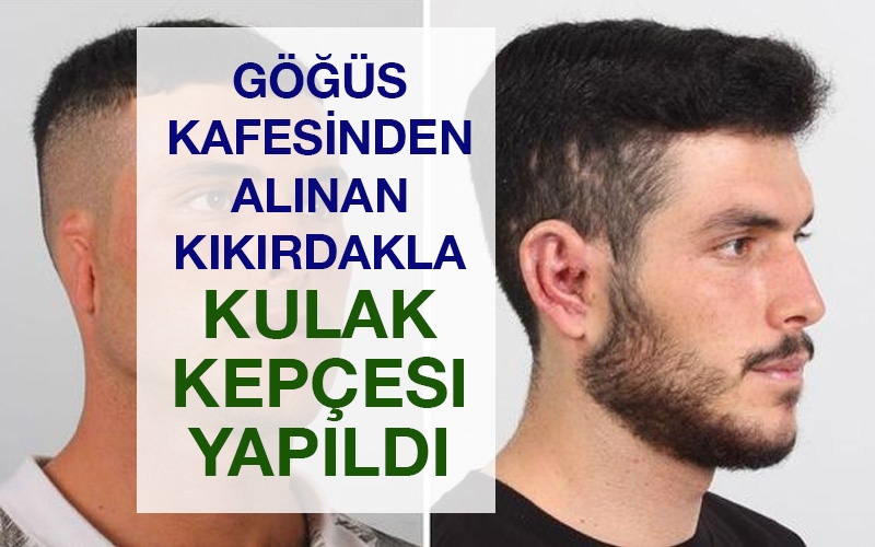 Göğüs kafesinden alınan kıkırdakla kulak kepçesi yapıldı