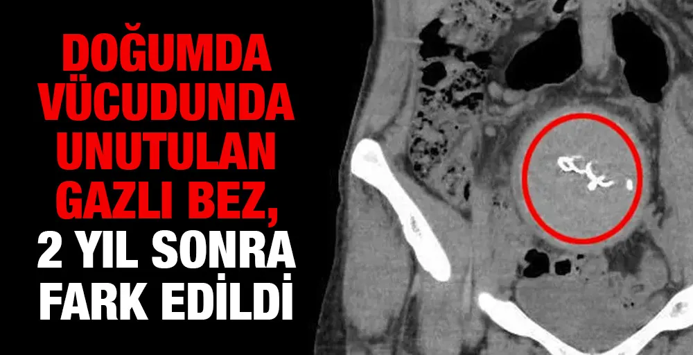 Doğumda vücudunda unutulan gazlı bez, 2 yıl sonra fark edildi