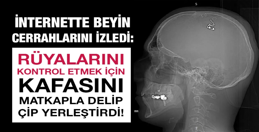 İnternette beyin cerrahlarını izledi: Rüyalarını kontrol etmek için kafasını matkapla delip çip yerleştirdi!