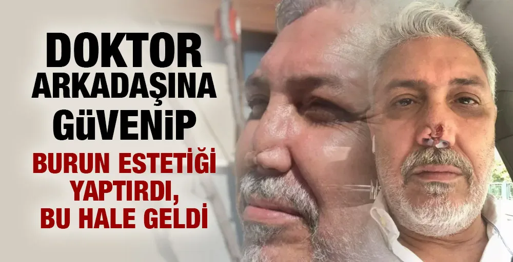 Doktor arkadaşına güvenip burun estetiği yaptırdı, bu hale geldi!