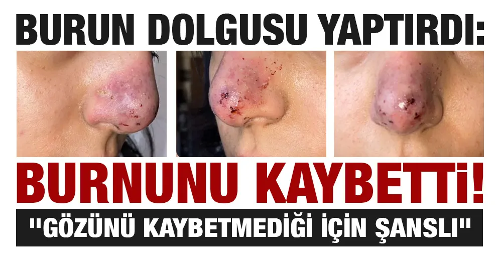 Burun Dolgusu Yaptırdı: Burnunu Kaybetti!