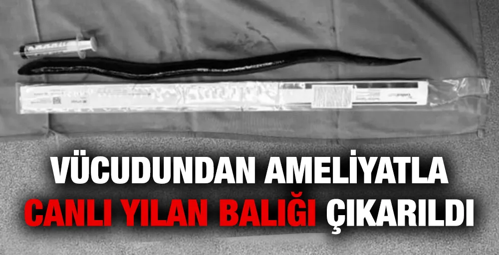 Vücudundan ameliyatla canlı yılan balığı çıkarıldı