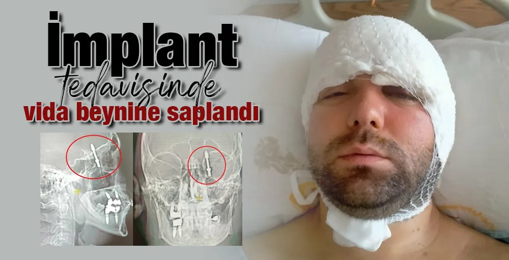 İmplant tedavisinde vida beynine saplandı