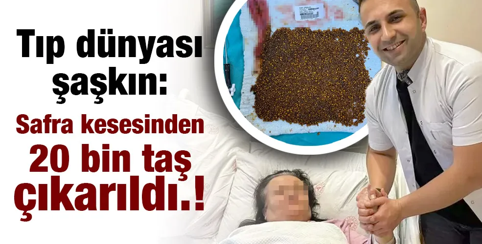 Tıp dünyası şaşkın:Safra kesesinden 20 bin taş çıkarıldı.!