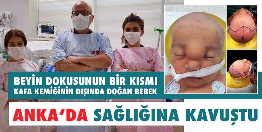 Beyin Dokusunun Bir Kısmı Kafa Kemiğinin Dışında Doğan Bebek Anka ‘da Sağlığına Kavuştu