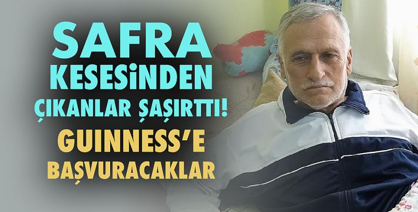 Safra kesesinden çıkanlar şaşırttı! Guinness’e başvuracaklar